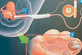 试管流程大概得多长时间，一边上班一边做试管可以吗？